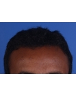 After Hair Transplant &nbsp;Front